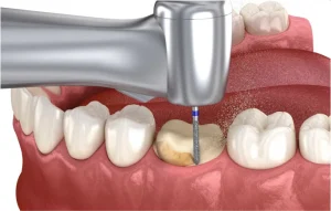 maquina perforando una caries