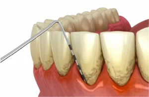 imagen dental limpiando encías